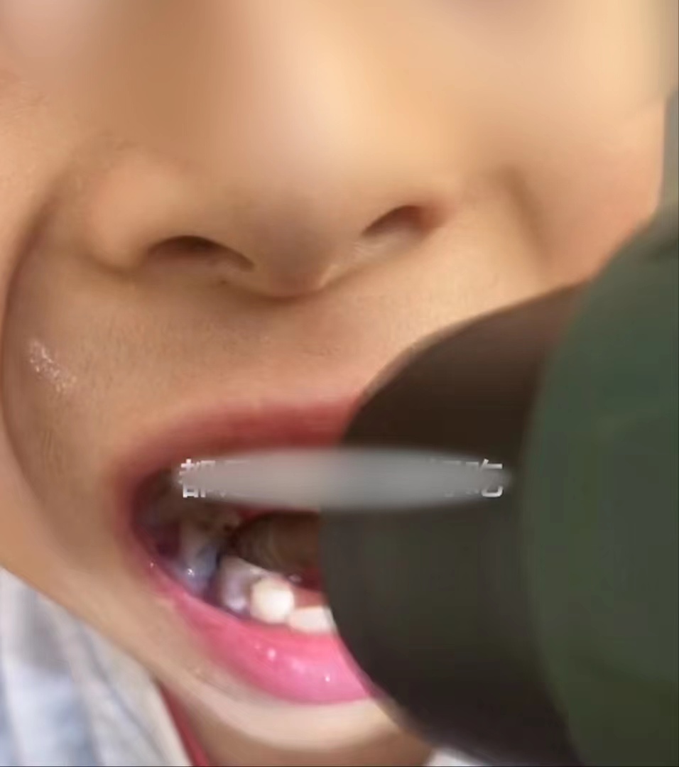 男孩长蛀牙爸爸用电钻钻牙止痛，相关